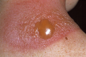 How Get Rid Sunburn Blisters