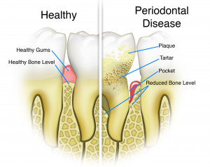 Periodontal disease is caused by the presence of bacteria which forms ...