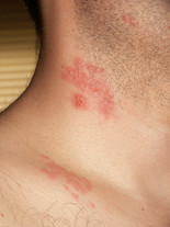 herpes zoster colloquially known as shingles is the reactivation from ...
