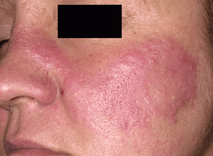 lupus rash Images and Graphics