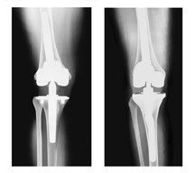 Bilateral Knee Replacement Surgery India, Price Bilateral Knee Surgery ...