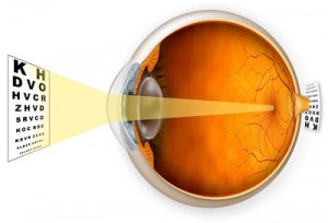 Refractive Errors - Hyperopia (Farsightedness)