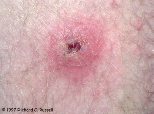 Definition of « Tick typhus »