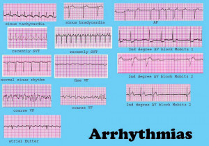 ... Arrhythmia And Irregular Heartbeat) - Electrocardiogram Interpretation