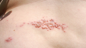 Treatment For Shingles Picture