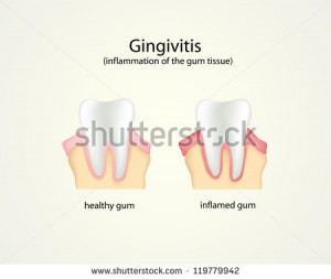 Gingivitis Stock Photos, Illustrations, and Vector Art