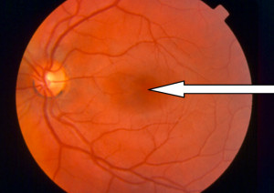 Unhealthy Optic Nerve Diabetes can also lead to