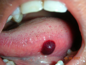 Blood Blister On Tongue