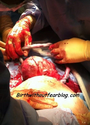 Delivery Of Baby Cesarean Cesarean birth video birth without fear