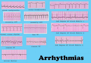 Cardiac Dysrhythmia (also Known As Arrhythmia And Irregular Heartbeat ...