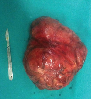 ... Specimen Of The Extra Gastrointestinal Tumors Macroscopic picture