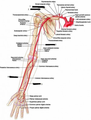 CT angiography shows splenic artery pseudoaneurysm arising just after