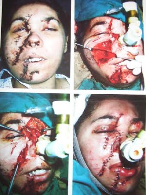 Muslims Kidnap Little Christian Girl And Horrifically Slice Her Face ...