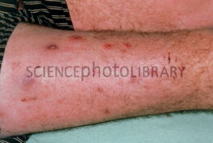 Boils on thigh of a patient suffering diabetes