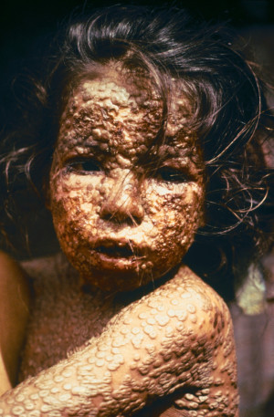 このバングラデシュの少女は、1973年に天然痘に感染 ...