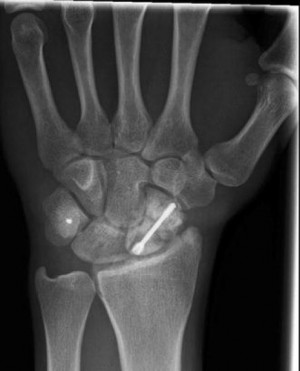 Scaphoid Fracture Wrist X Ray