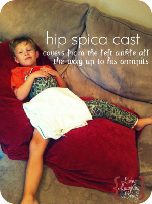 Hip Spica Cast Femur Fracture