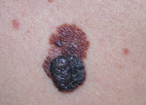 malignant melanoma skin cancer