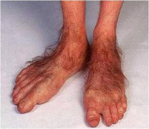 ugly-feet.jpg#ugly%20%20feet