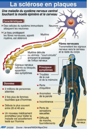 Nouveau médicament prometteur pour le traitement de la sclérose en ...