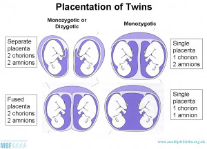 identical twin pregnancy