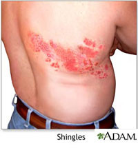 ... shingles skin cincinnati female news reporters shingles and jury duty