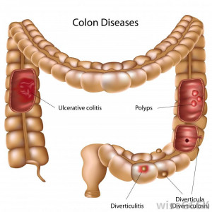 diagram showing ulcerative colitis and other colon problems that ...