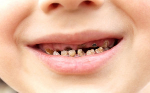 rotten-teeth-child_2383492k.jpg