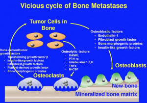 bone metastasis -- Prostate Cancer Facts