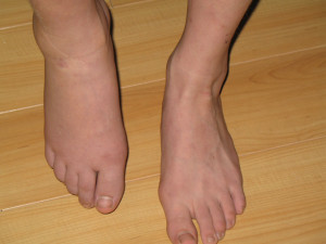 Football Broken Nose