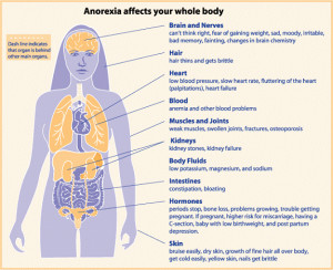 Eating Disorders, Anorexia Nervosa – SIGNS, SYMPTOMS, CAUSES ...