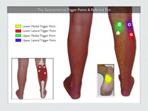 Trigger Point for Calf Pain