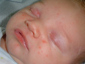 Allergy Rash On Babies