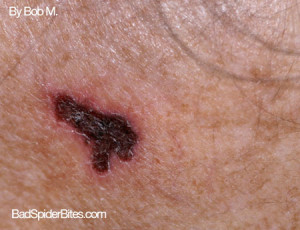 Insect Bites – ID Help Comment-