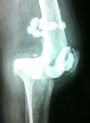 patient came to UC San Diego after having a failed knee replacement ...