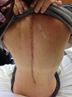 Scoliosis Surgery: What Scars And Recovery Look Like From A Real ...
