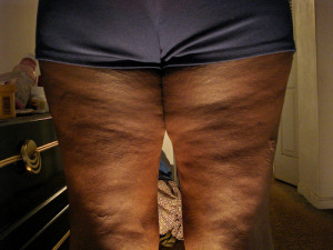Cottage Cheese Thighs Photo