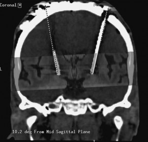 Quote: Originally Posted by trent123. Medical Coding > Outpatient ...