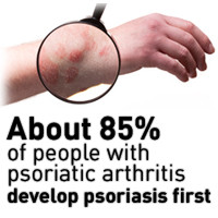 Psoriatic-arthritis.jpg