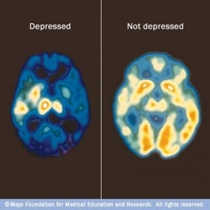... loss of neurotransmitter activity in the brain of a depressed person
