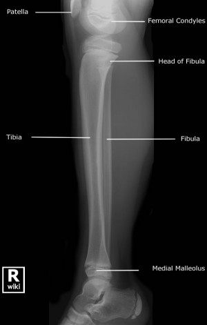 Tib Fib X ray