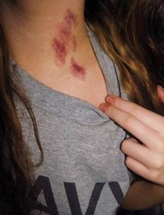 How to Get Rid of Hickeys Fast and Naturally