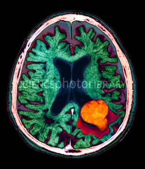 Brain lesion, MRI scan