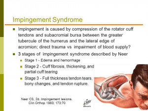 three stages of subacromial impingement