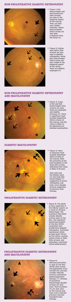 Too much 'Eye Candy': The growing concern of Diabetic Retinopathy