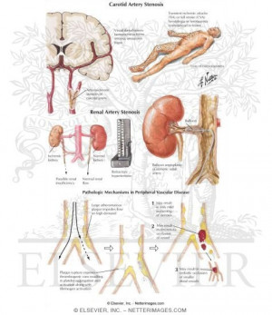 Internal Carotid Artery Stenosis