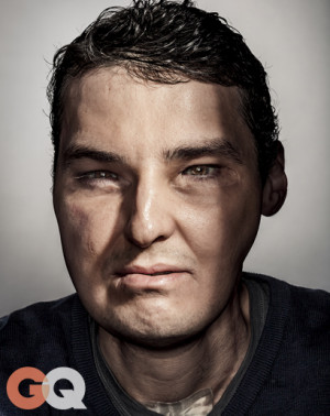 Face Transplant Patient Profiled By GQ Has A Story That Will Amaze You ...