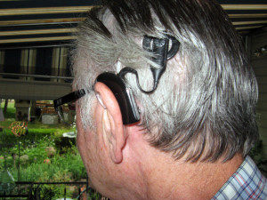 Magnetic Implants Gone Wrong A Cochlear Implant picture