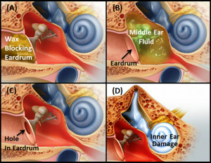 Causes Conductive Hearing Loss
