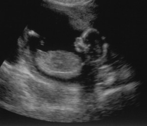 Week Ultrasound Image Baby